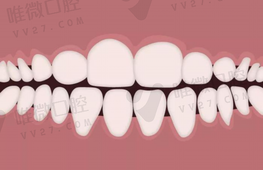 意大利美塑树脂补牙能用多久（意大利树脂补牙的牌子）(图1)